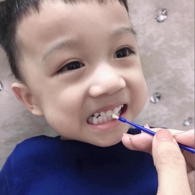 GEL NGỪA SÂU RĂNG, MÒN RĂNG, MỦN RĂNG VECNI FLUOR - ANAMELAST