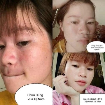 KEM NÁM HUYỀN PHI-SẠCH NÁM TÀN NHANG DƯỠNG DA TRẮNG SÁNG ĐỀU MÀU 415.030đ