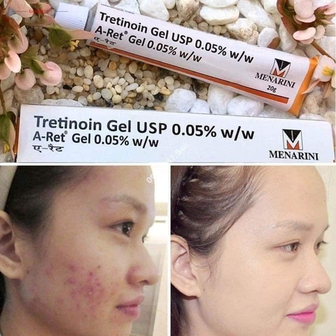 KEM TRỊ MỤN, GIẢM NẾP NHĂN TRẺ HÓA DA TRETIOIN - MENARINI