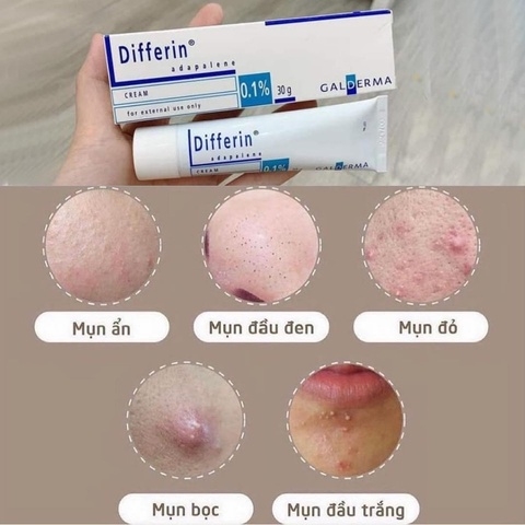 KEM TRỊ MỤN DIFFERIN PHÁP - GALDERMA