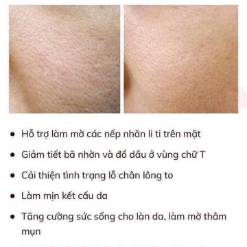 SERUM SE KHÍT LỖ CHÂN LÔNG, DƯỠNG TRẮNG DA NIACINAMIDE - BALEA