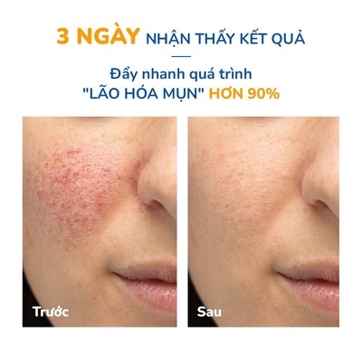 GEL GIẢM MỤN THÂM SẸO & CẢI THIỆN DA DẦU, MỤN 15ML - NEOTHERA