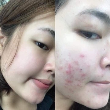 KEM TRỊ MỤN HÀN QUỐC PAIR ACNE - LION