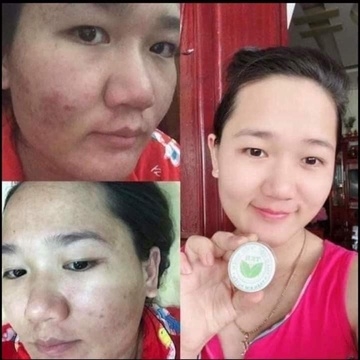 KEM MỤN DƯỠNG DA THẢO MỘC TKH - HỒNG ÁNH STORE
