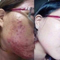 KEM MỤN DƯỠNG DA THẢO MỘC TKH - HỒNG ÁNH STORE