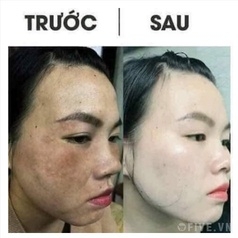 KEM KHỬ NÁM KHỬ MỤN TRẮNG DA KONE THÁI LAN - GDN