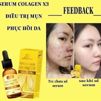 SERUM MỤN COLLAGEN X3 - HÀNG CHÍNH HÃNG CÔNG TY MỸ PHẨM ĐÔNG ANH KT1-GDN