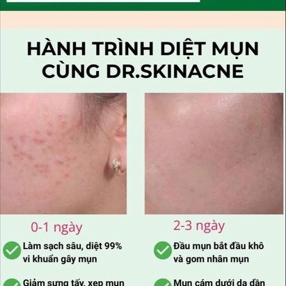 KEM GIẢM MỤM THẨM DR.SKINACNE 15G KT-GDN
