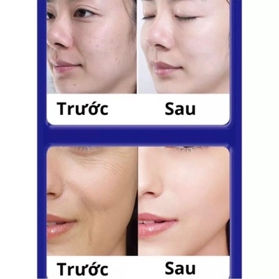 KEM GIẢM NÁM, CHỐNG NHĂN VÀ TRẺ HÓA DA UCM NHẬT BẢN - GDN