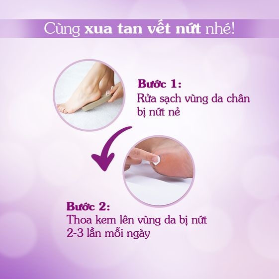 KEM TRỊ NỨT GÓT CHÂN ORISS 30G