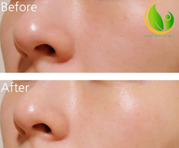 Serum Tinh chất dưỡng ẩm sâu Klairs Rich Moist Soothing