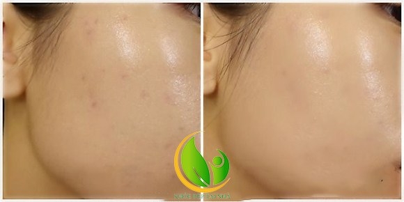 Serum Tinh chất dưỡng ẩm sâu Klairs Rich Moist Soothing