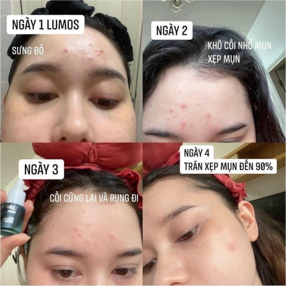 Tinh Chất Trị Mụn Lumos Ance 5ml-hàn