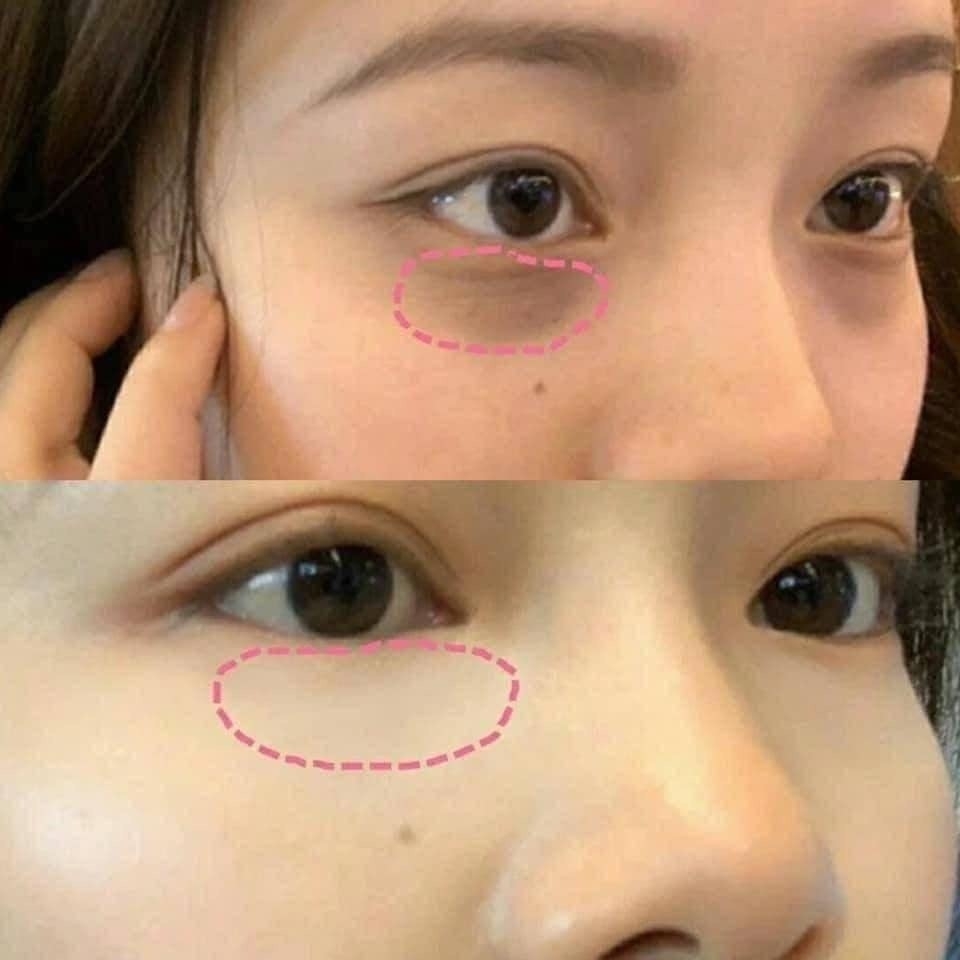 Kem mắt trị quầng thâm mắt Kumargic - Nhật