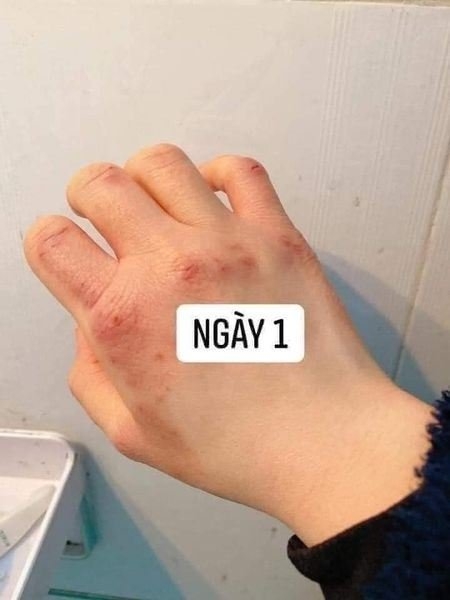 Kem trị á sừng Keratinamin Kowa Cream giảm nứt nẻ, khô ráp Nhật Bản
