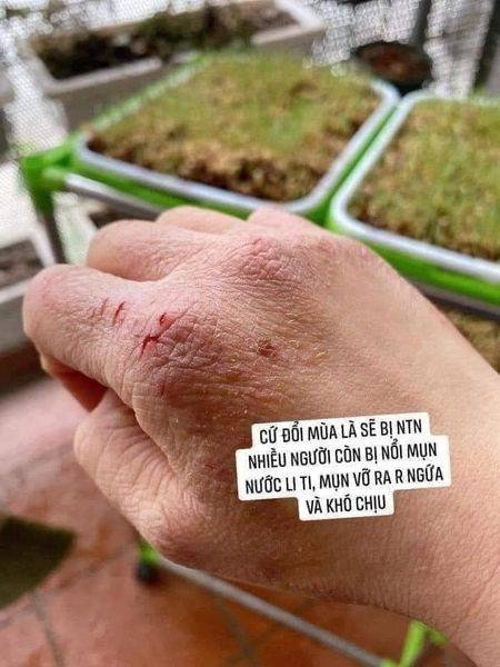 Kem trị á sừng Keratinamin Kowa Cream giảm nứt nẻ, khô ráp Nhật Bản