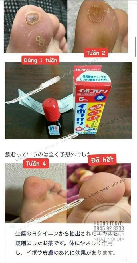 Thuốc đặc trị MỤN CÓC, MỤN CƠM, MỤN THỊT, NỐT RUỒI, MẮT CÁ CHÂN,THỊT THỪA..