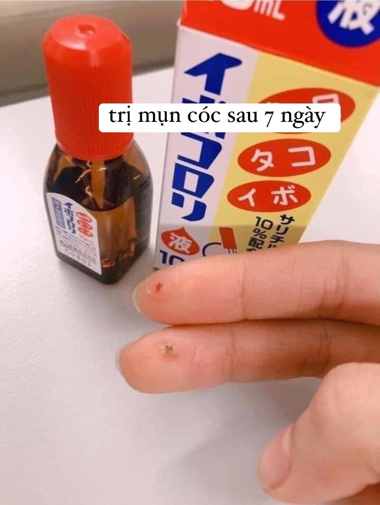 Thuốc đặc trị MỤN CÓC, MỤN CƠM, MỤN THỊT, NỐT RUỒI, MẮT CÁ CHÂN,THỊT THỪA..