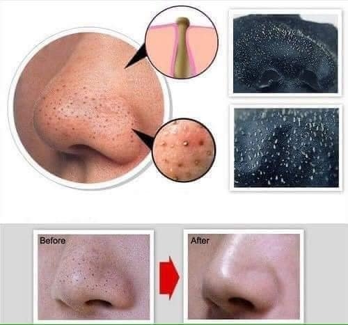 GEL LỘT MỤN KOSE _Gel 25g Nhật Bản