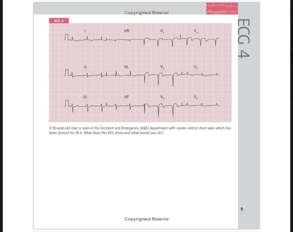 Sách ngoại văn 150 ECG Cases 5th