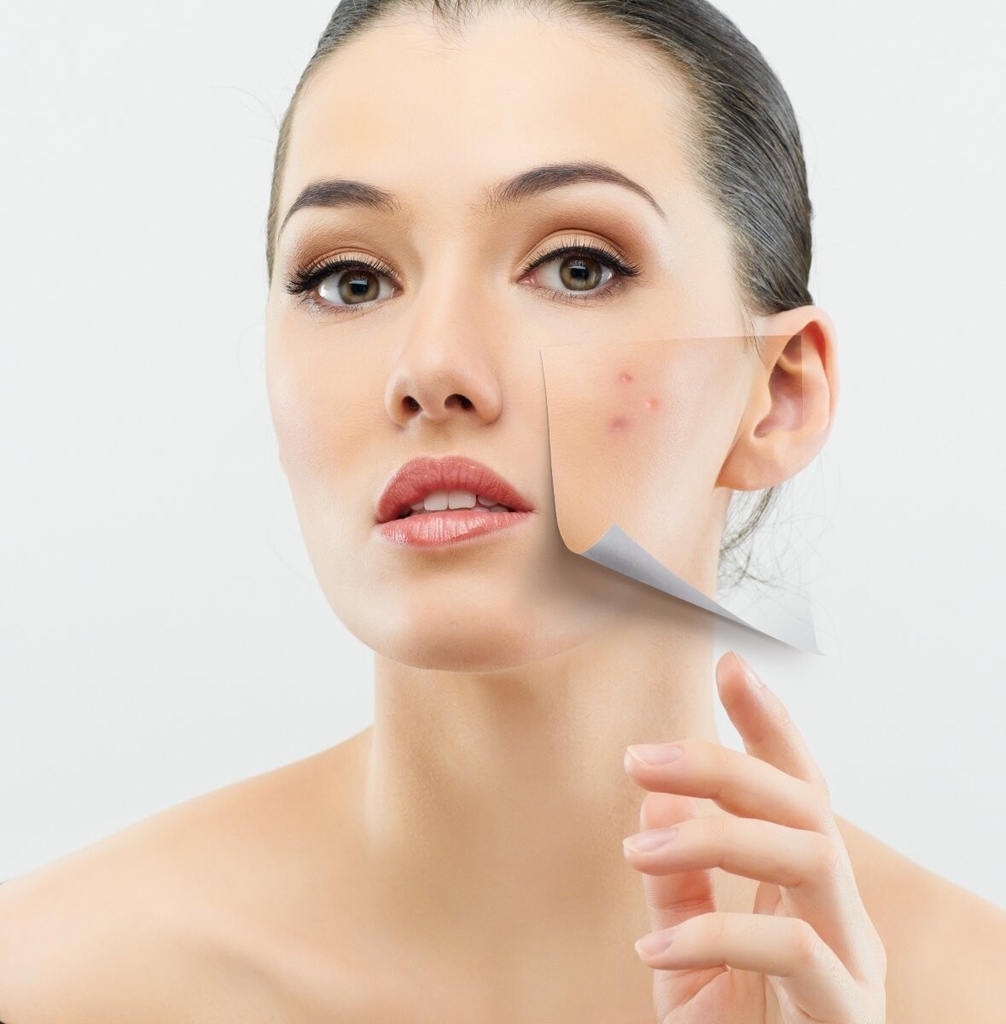 Gel chấm mụn SVR Sebiaclear Cicapeel làm giảm mụn viêm sưng - 15ml
