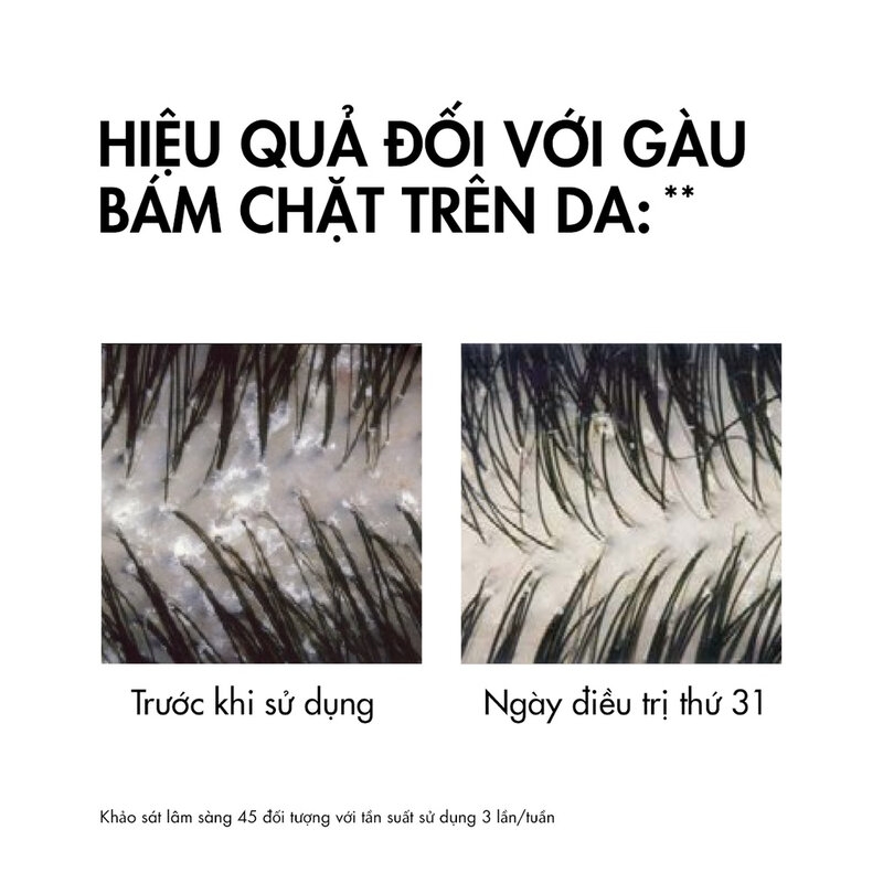 Dầu Gội Vichy Sạch Gàu Cho Da Đầu Dầu, Ngứa