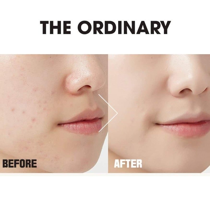 Serum The Ordinary Niacinamide 10% + Zinc 1% Kiềm Dầu Giảm Mụn - Fullbox - Hàng US