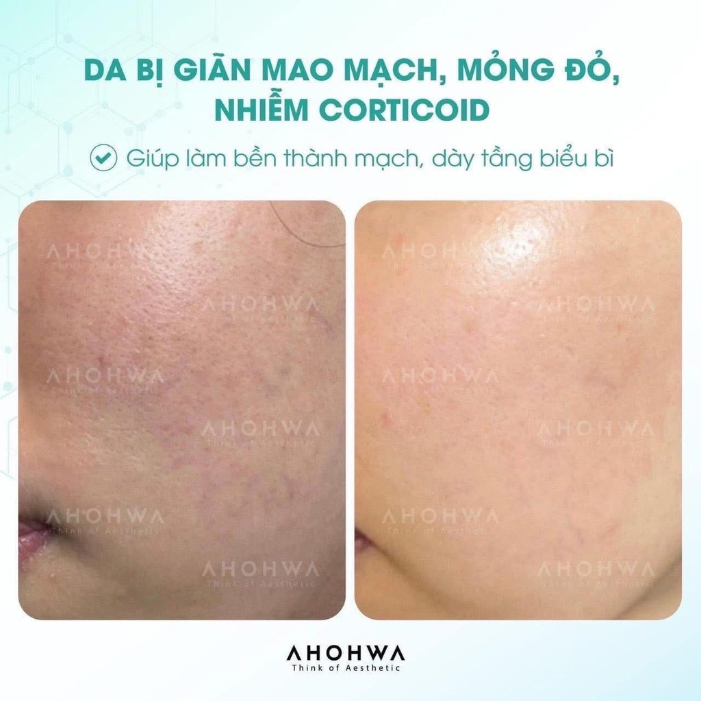 Kem Ahohwa Vitamin K Cream 12g Phục Hồi Giảm Thâm Đỏ Da - Nobox - Hàng Công Ty