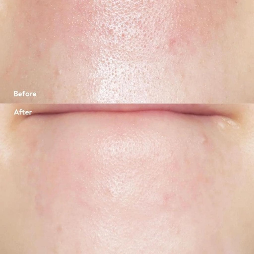 Dụng Cụ Làm Sạch Mụn Đầu Đen ILSO Deep Clean Master