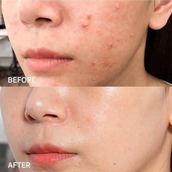 Serum Giảm Mụn, Mờ Thâm SVR Sebiaclear Correcteur Global - 30ml Fullbox