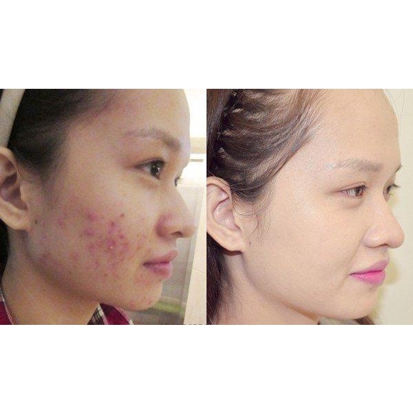 SRM Compliment No Problem - ĐỎ SALICYLIC ACID 200ml