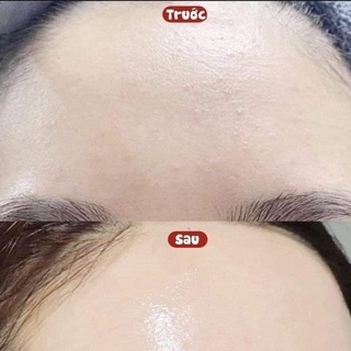 Kem Dưỡng Floslek Anti Acne Mattifying Cream Tuýp 50ml