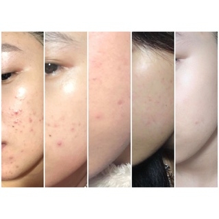 Gel Megaduo Giảm Mụn Ngừa Thâm Megaduo Gel Việt Nam - Tuýp 15g