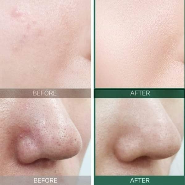 Serum Some By Mi AHA BHA PHA 30 Days Miracle Chai 50ml