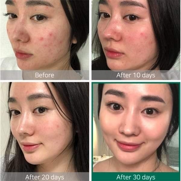 Serum Some By Mi AHA BHA PHA 30 Days Miracle Chai 50ml