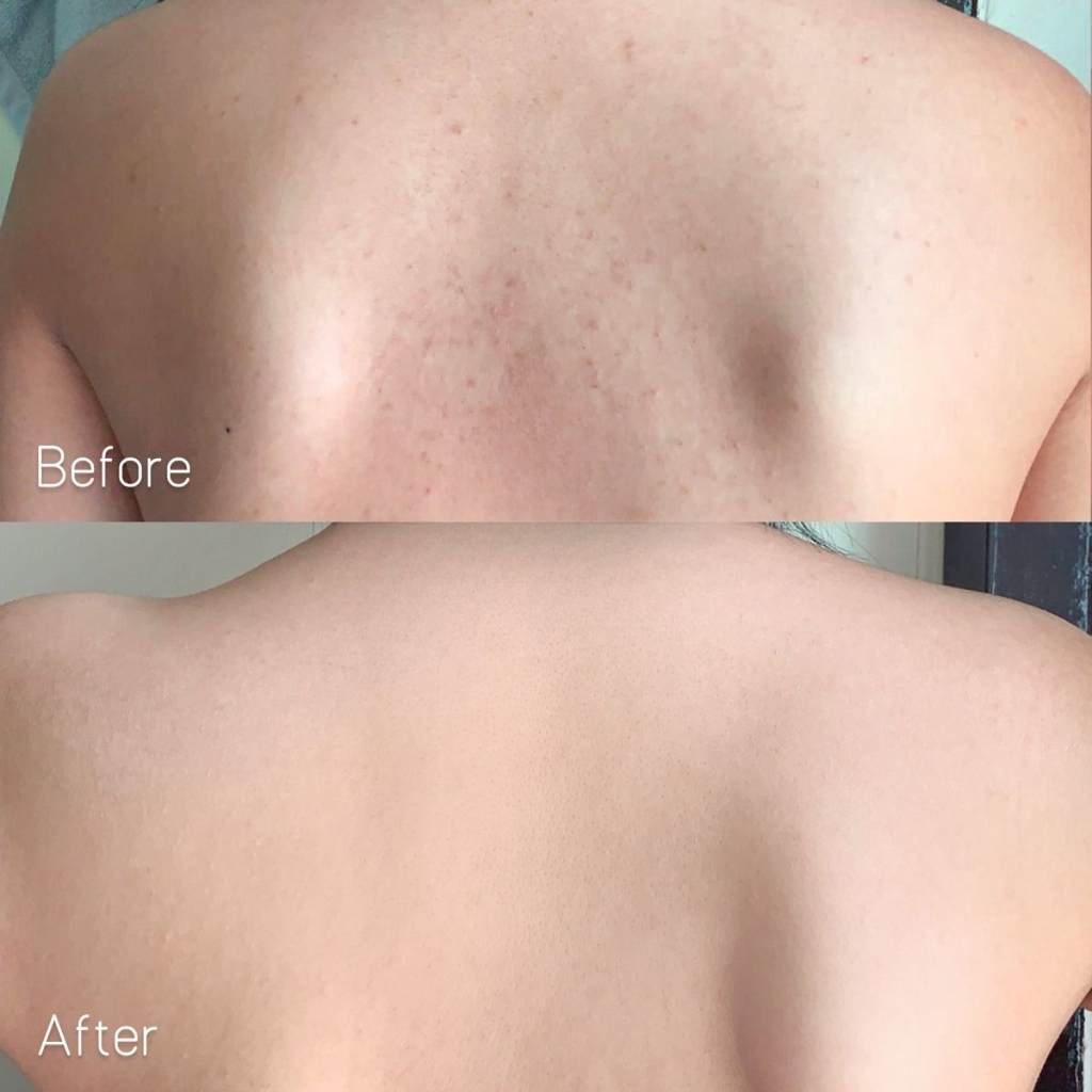 Xà Phòng Derladie Body Cleansing Bar For Blemish Skin Sạch Sâu Giảm Mụn Mờ Thâm Hàn Quốc 50g