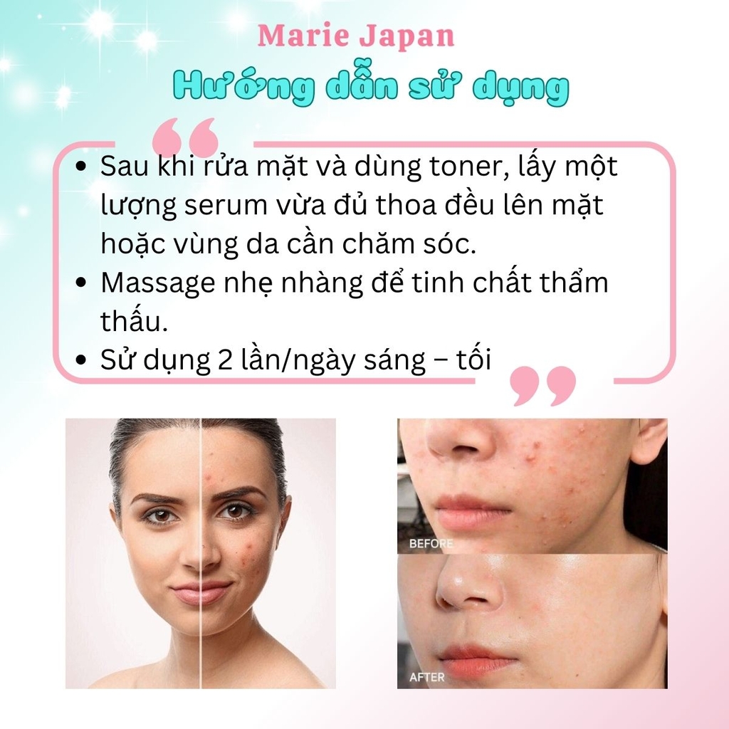 Serum Floslek Giảm Mụn Kiền Dầu Se Lỗ Chân Lông Anti Acne Soothing Tuýp 50ml