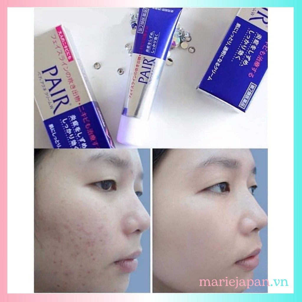 Kem Mụn Pair Giảm Mụn Sưng Viêm Mờ Thâm Nhật Bản