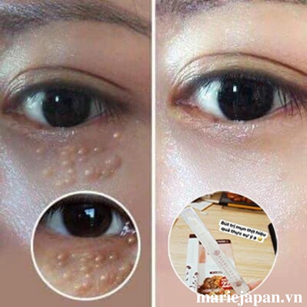Tinh Chất Tsubuporon Night Patch Nhật Bản - BÔI NỐT RUỒI 20g