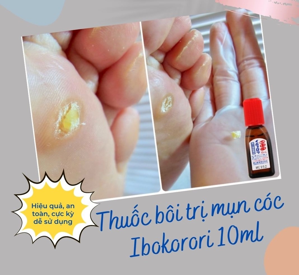 Tinh Chất Bôi Mụn Cóc Ibokorori Nhật Bản Chai 10ml