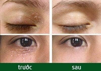 Tsubuporon - Kem Hỗ Trợ Giảm Mụn Thịt Tsubuporon (1.8ml)