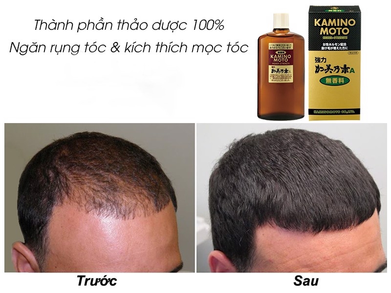 TINH DẦU DƯỠNG KÍCH THÍCH MỌC TÓC KAMINOMOTO 200ML