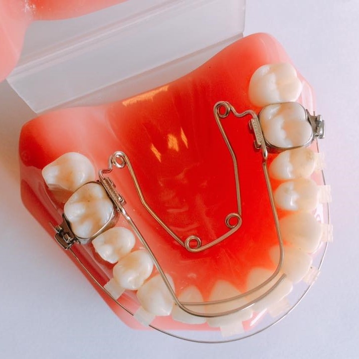 Khí cụ nong hàm Quad Helix