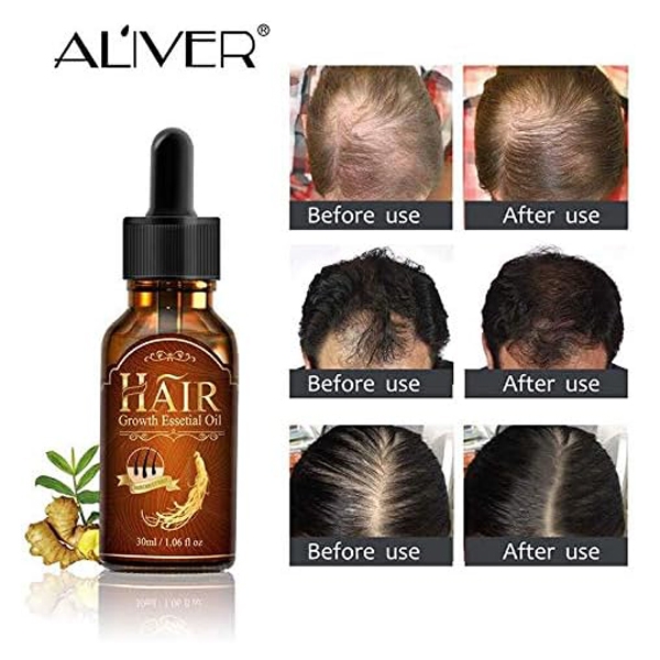 Tinh dầu dưỡng tóc, kích thích mọc tóc Aliver Hair Growth Essential Oil