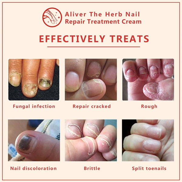 Kem dưỡng móng tay Aliver The Herb Nail Repair