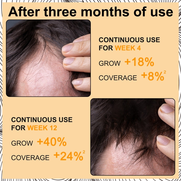 Bọt giúp mọc tóc với Biotin hỗ trợ mọc lại tóc để tóc dày Elaimei Hair Growth Foam