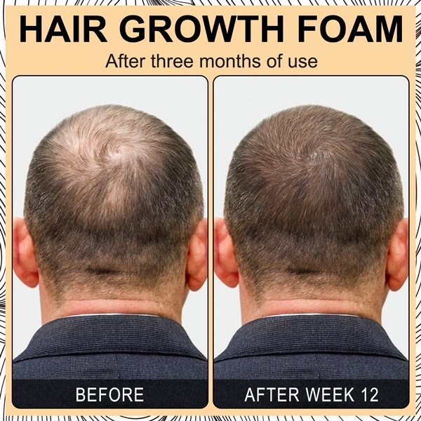 Bọt giúp mọc tóc với Biotin hỗ trợ mọc lại tóc để tóc dày Elaimei Hair Growth Foam