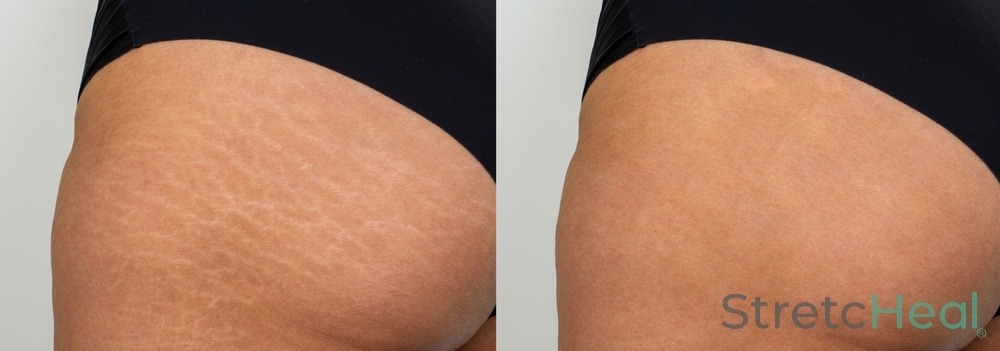 Kem Trị Rạn Da StretcHeal  Anti Stretch Marks & Scars Cream