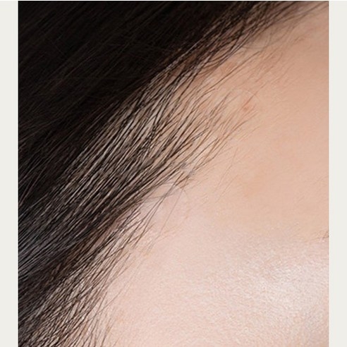 Miếng dán trị mụn Acnes 66 miếng