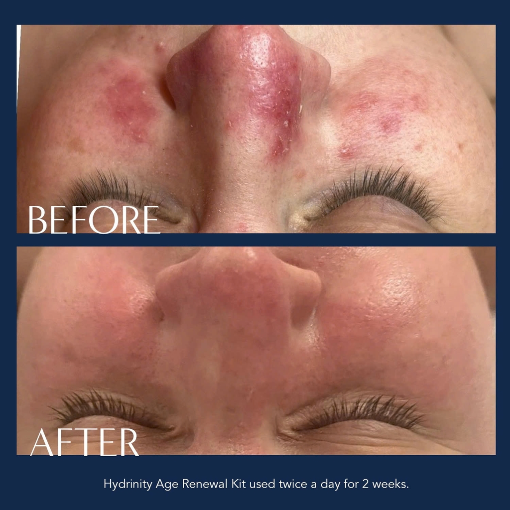 HYDRINITY Restorative HA Serum: Tinh Chất Cấp Ẩm Chuyên Sâu, Phục Hồi Tức Thì Với HA Siêu Nạp